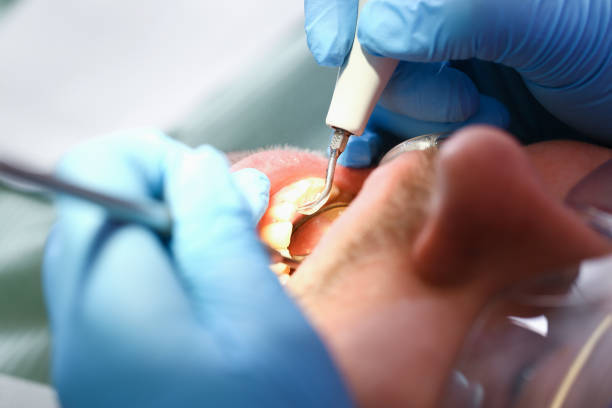 Best Emergency Wisdom Tooth Extraction in Kettering, OH
